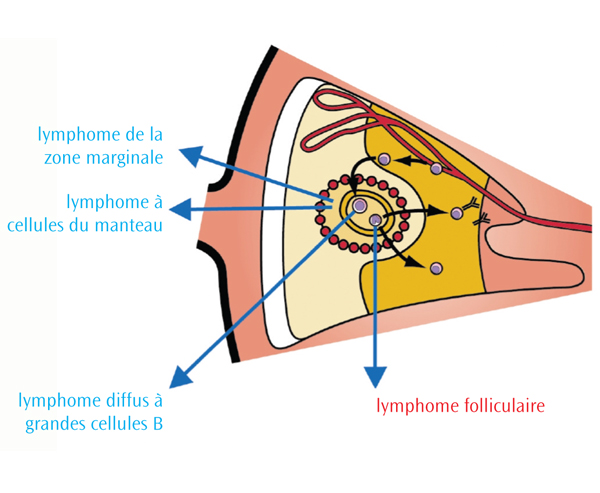 Les différents types de lymphomes non hodgkiniens - Lymphoma Canada