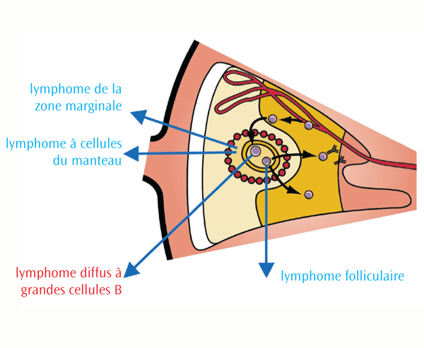 Les différents types de lymphomes non hodgkiniens - Lymphoma Canada