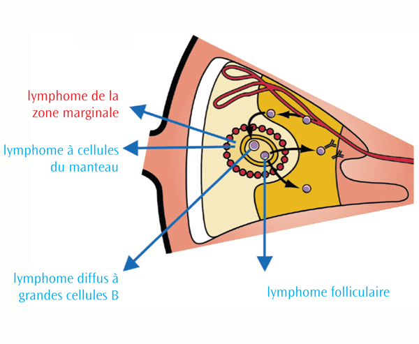 Les différents types de lymphomes non hodgkiniens - Lymphoma Canada