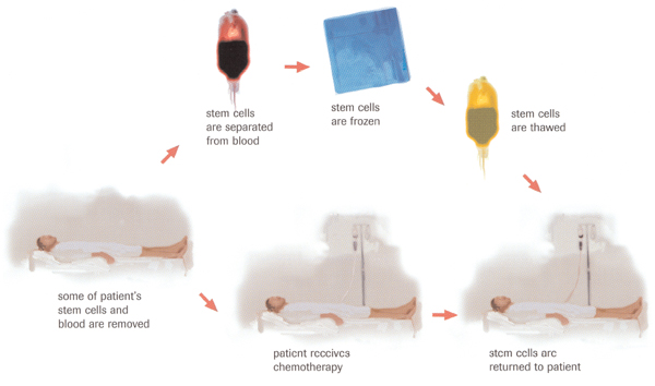 Autologous transplant