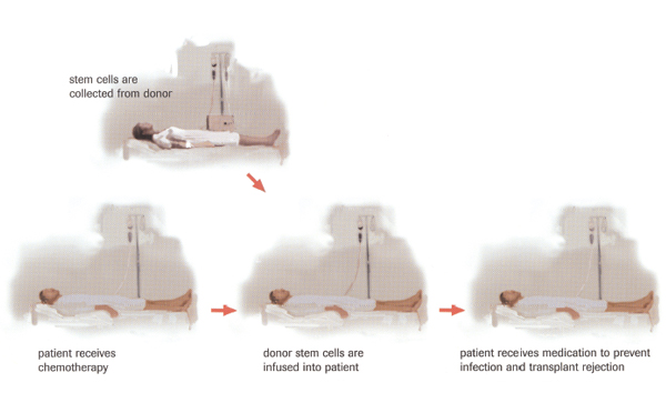 Allogeneic transplant