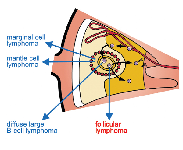 Transformation de Richter - Lymphome Australia