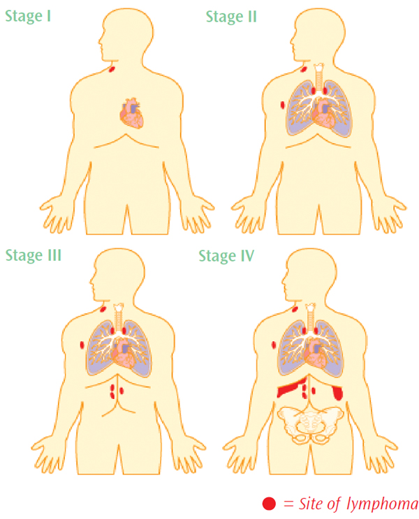 Photo description of lymphoma stages