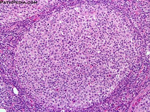 image_name_-_follicular-lymphoma-4-ln022-1-4