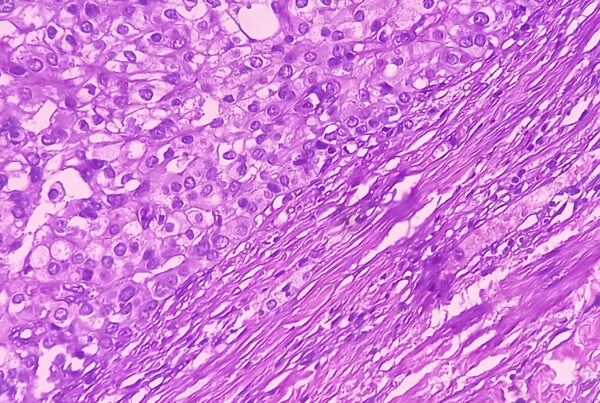 lymphoma canada
